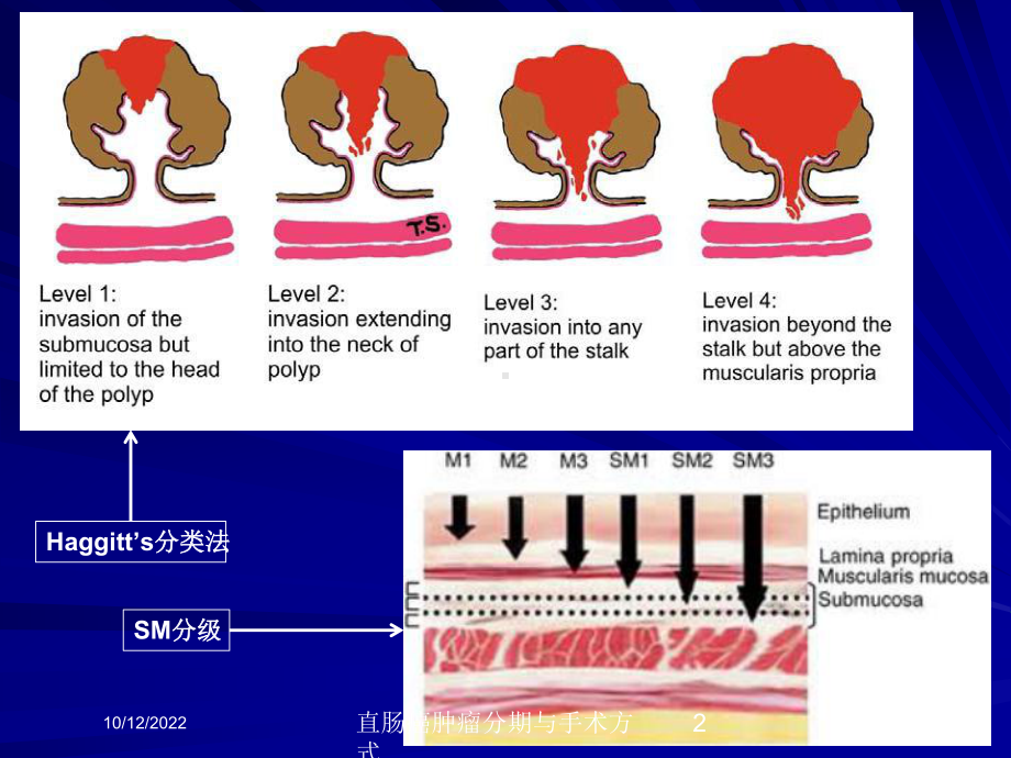 直肠癌肿瘤分期与手术方式培训课件.ppt_第2页