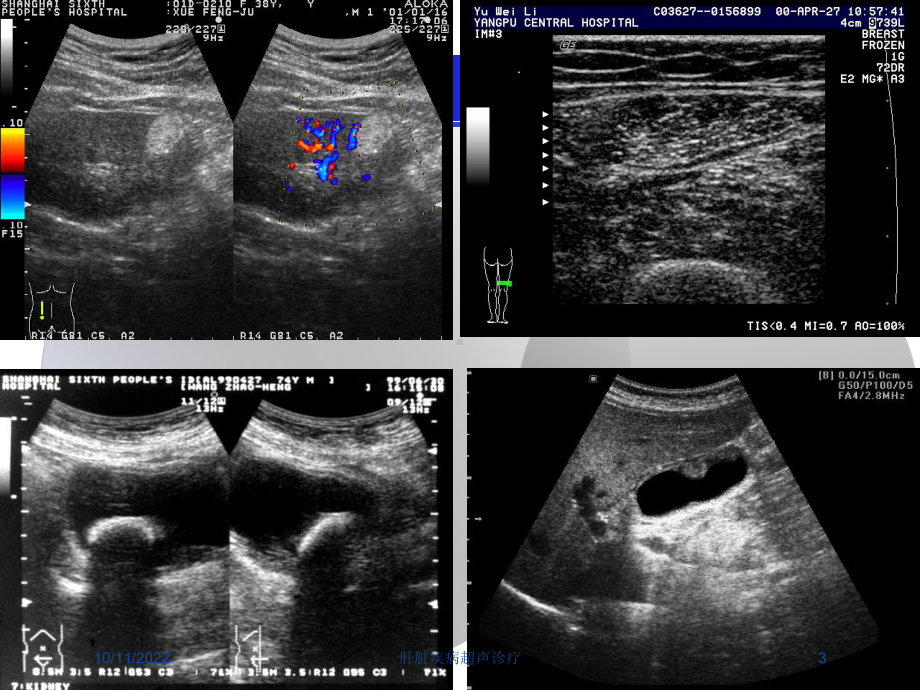 肝脏疾病超声诊疗培训课件.ppt_第3页