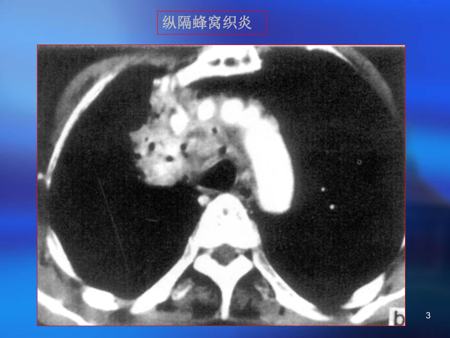 纵膈常见疾病的CT表现课件-2.ppt_第3页