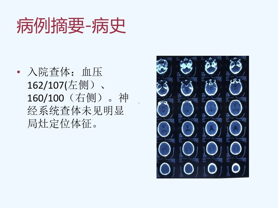 缺血性脑卒中病因及发病机制诊断从病例到解读课件.ppt_第3页