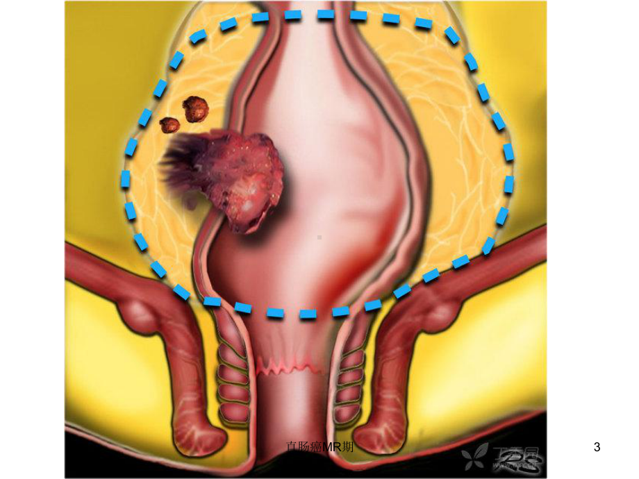 直肠癌MR期培训课件.ppt_第3页