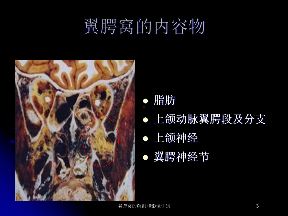 翼腭窝的解剖和影像识别培训课件.ppt_第3页