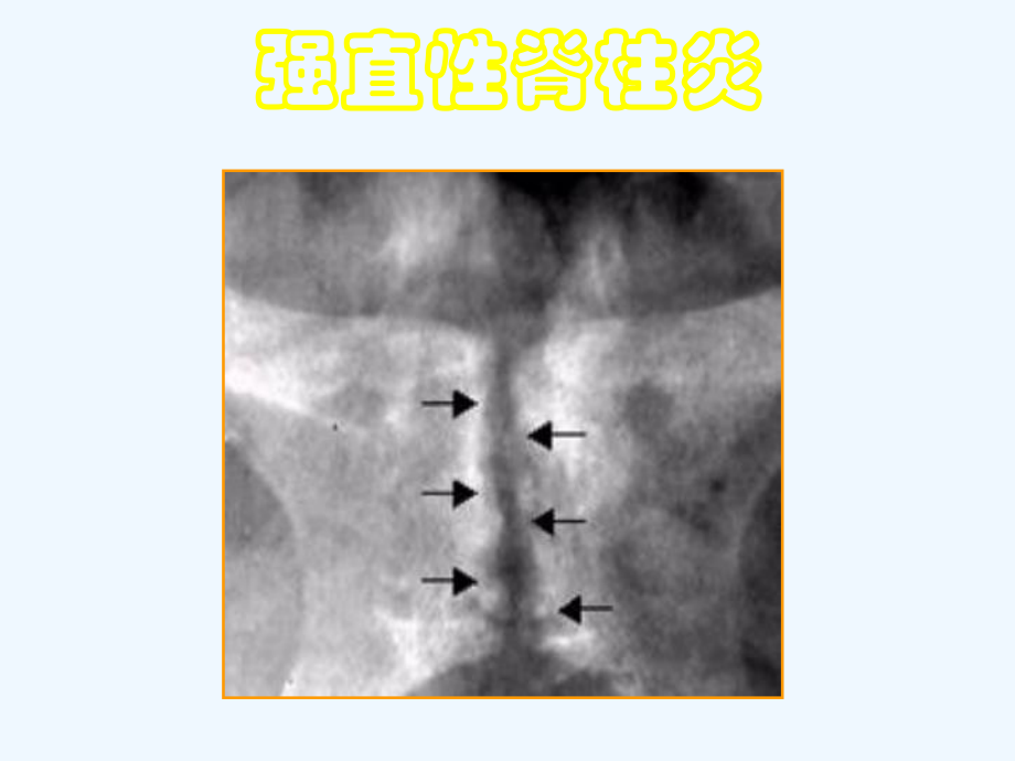 痛风强直性脊柱炎课件.ppt_第1页