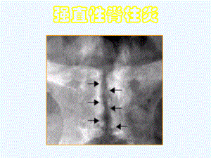 痛风强直性脊柱炎课件.ppt