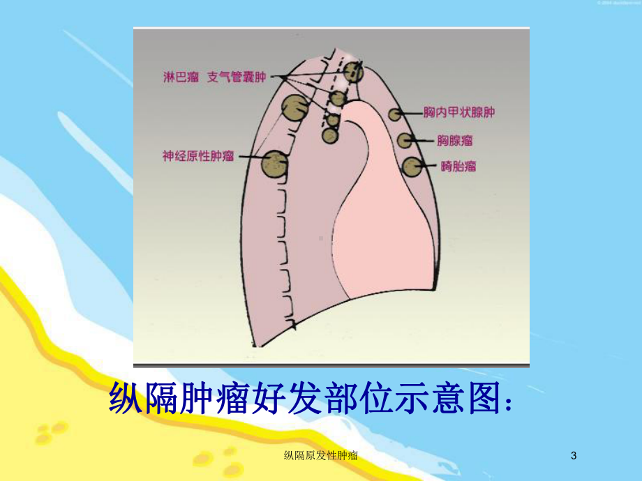 纵隔原发性肿瘤培训课件.ppt_第3页