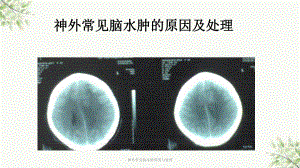 神外常见脑水肿原因与处理课件.ppt