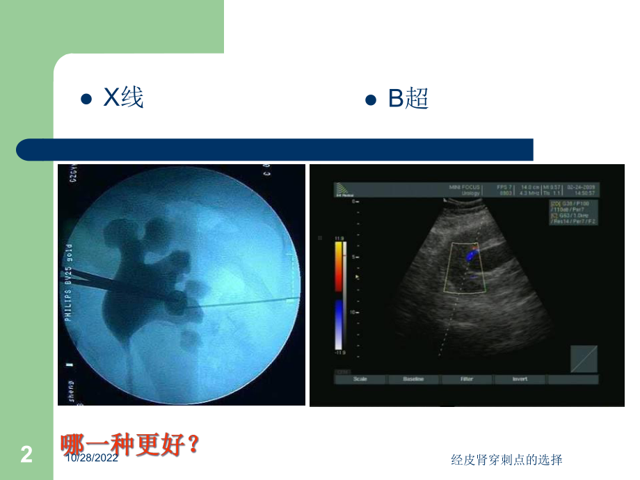 经皮肾穿刺点的选择培训课件.ppt_第2页