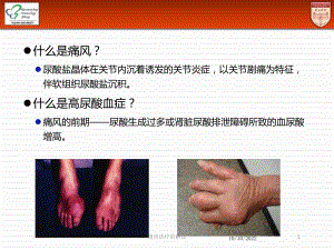 痛风诊疗的解读培训课件.ppt