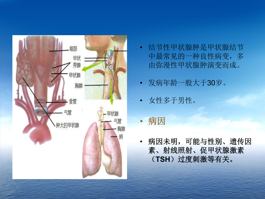 结节性甲状腺肿培训课件.ppt_第3页