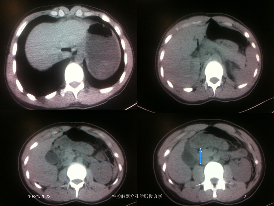 空腔脏器穿孔的影像诊断培训课件.ppt_第2页