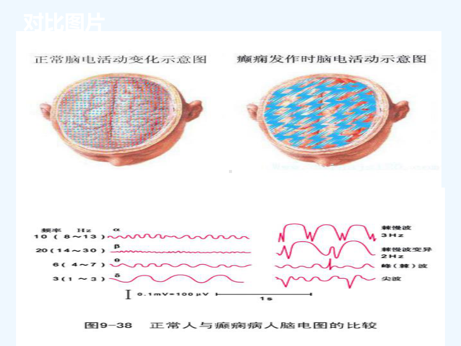 癫痫的发病机制及临床表现课件.ppt_第3页