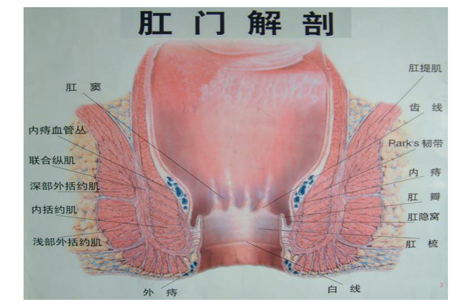 痔疮术进展及术前后护理课件.ppt_第3页