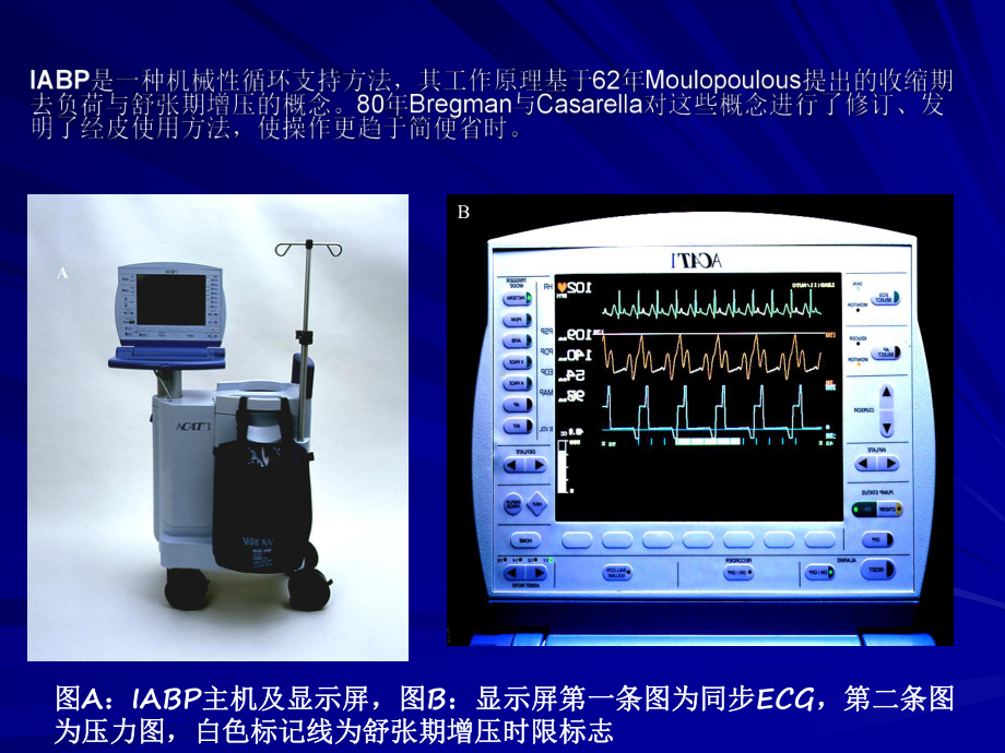 IABP-安贞医院解析课件.ppt_第2页