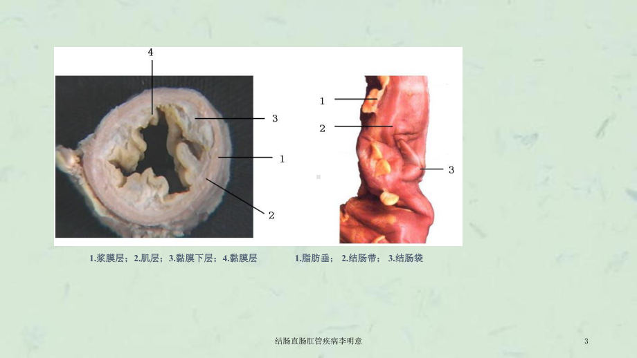 结肠直肠肛管疾病课件.ppt_第3页