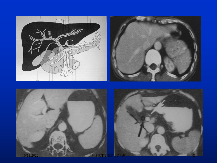 肝胆CT专业知识宣讲培训课件.ppt_第2页