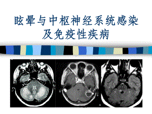 眩晕与中枢神经系统感染及免疫性疾病课件.ppt