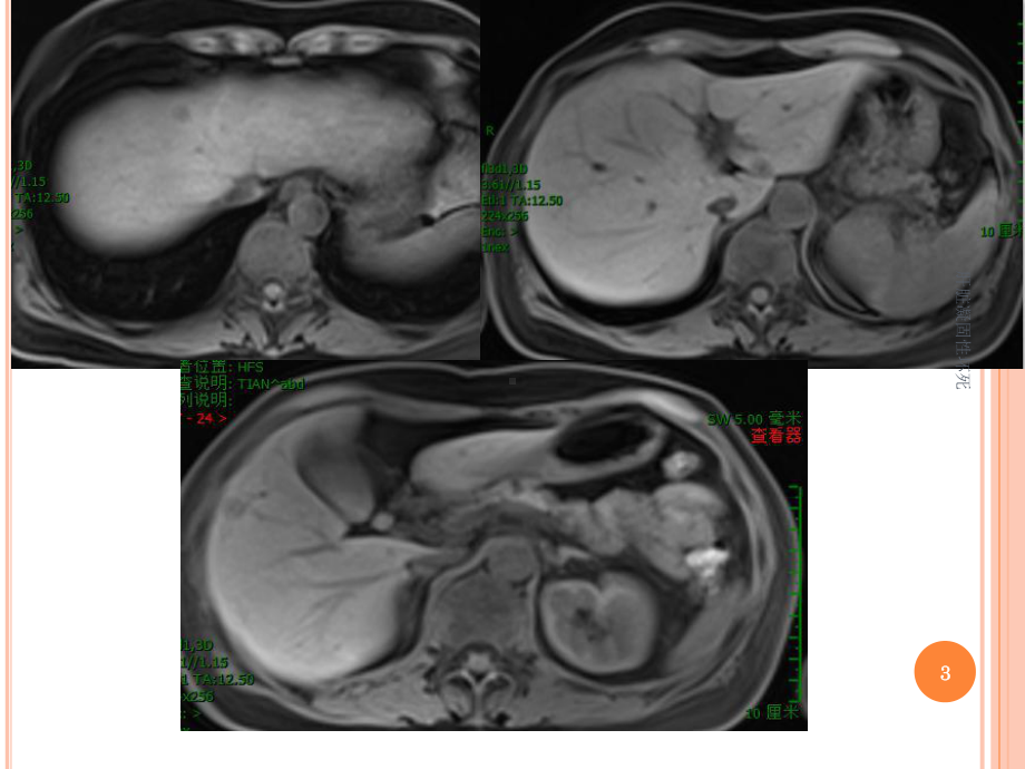肝脏凝固性坏死课件.ppt_第3页