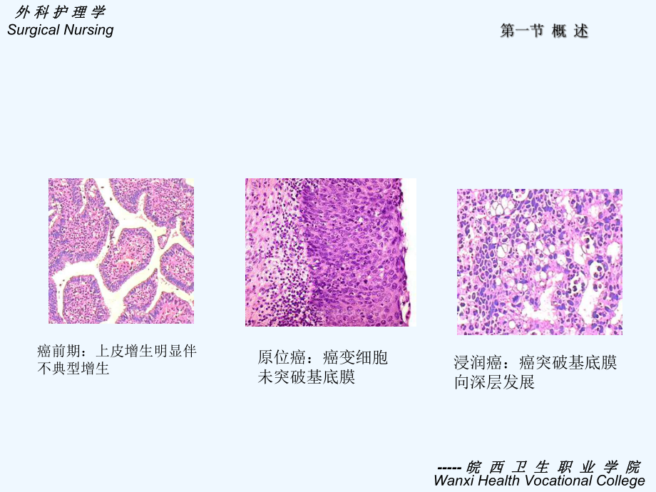 十章肿瘤病人护理中专好课件.ppt_第3页