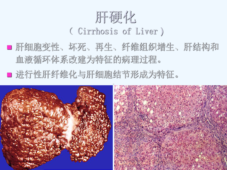 肝硬化结节分类及评价课件.ppt_第2页