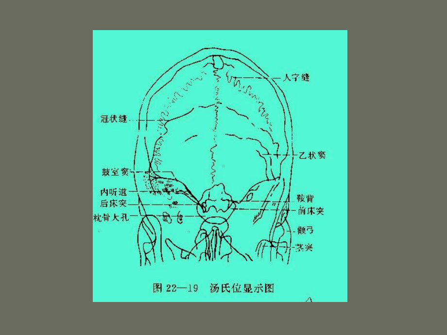 耳内疾病影像诊断课件.pptx_第3页