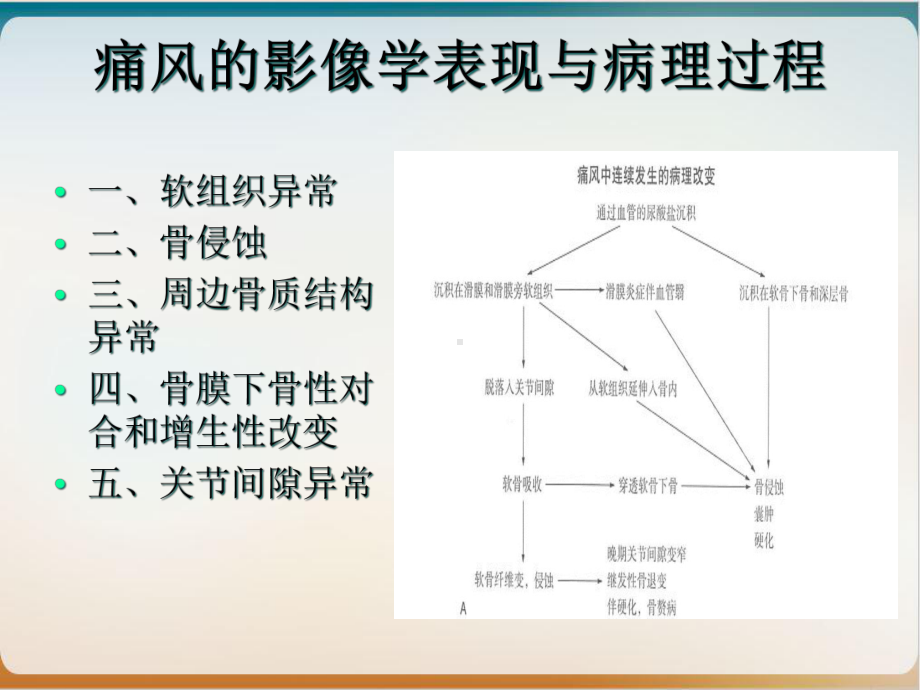 痛风的影像学表现及进展示范课件.ppt_第2页