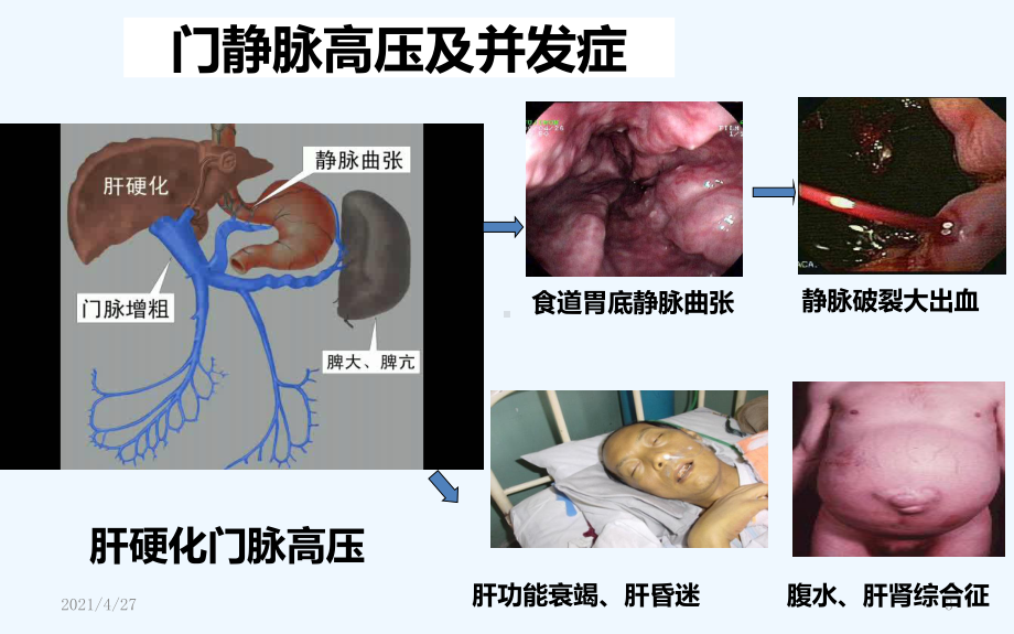 肝硬化治疗利器TIPS手术课件2.ppt_第3页