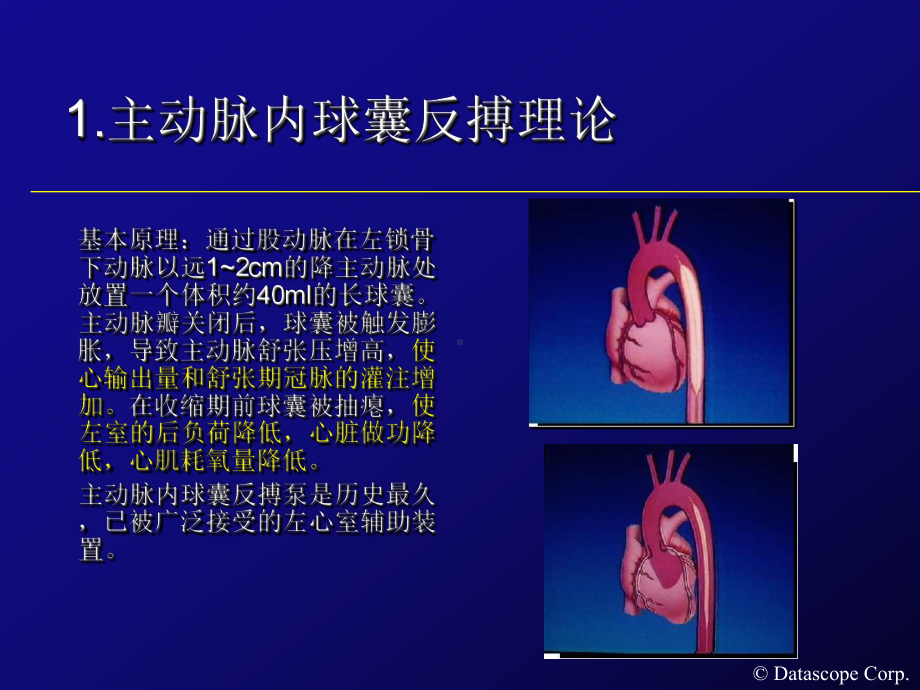 IABP主动脉内球囊反搏泵的临床使用课件.ppt_第2页