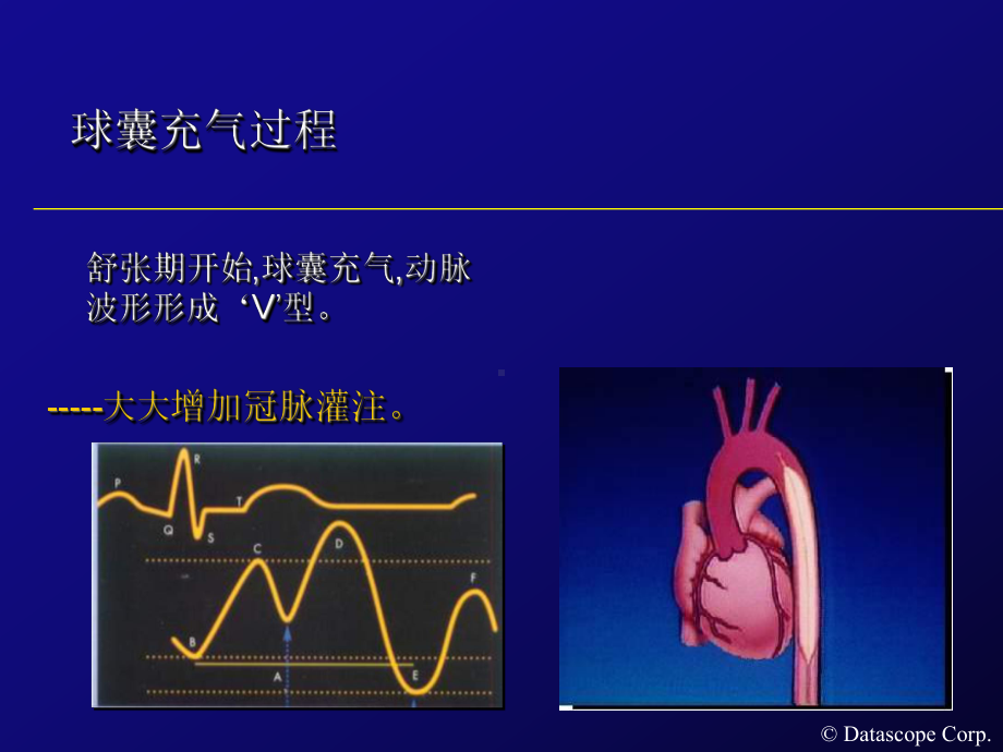 IABP主动脉内球囊反搏泵的临床使用课件.ppt_第3页