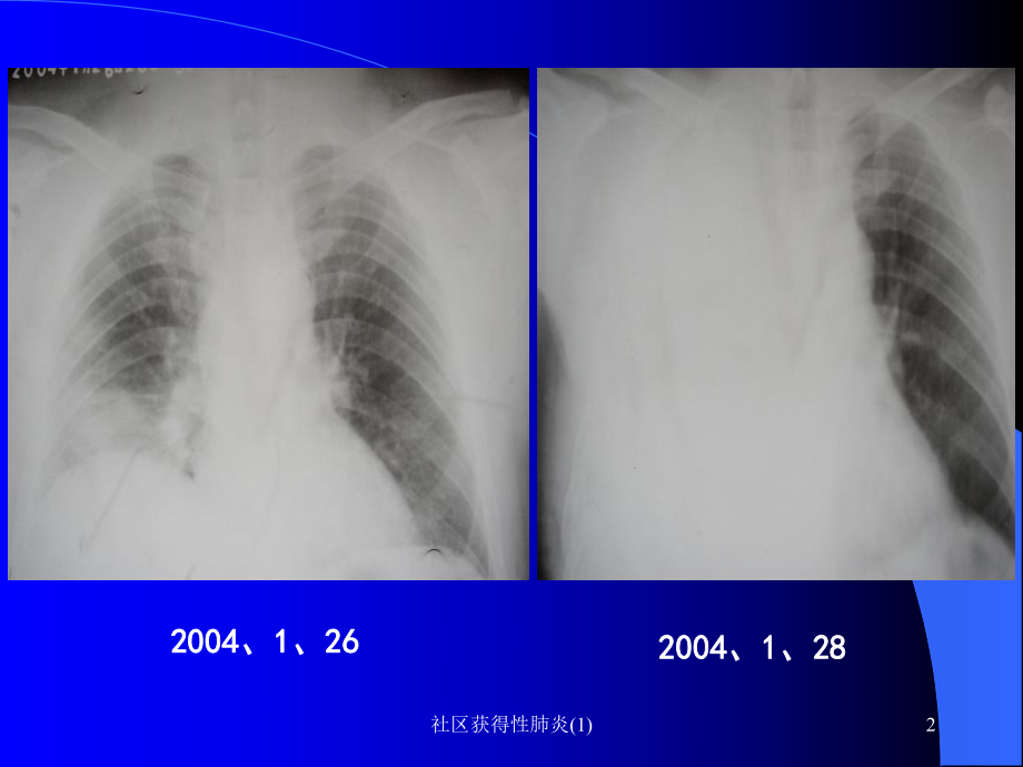 社区获得性肺炎-课件.ppt_第2页