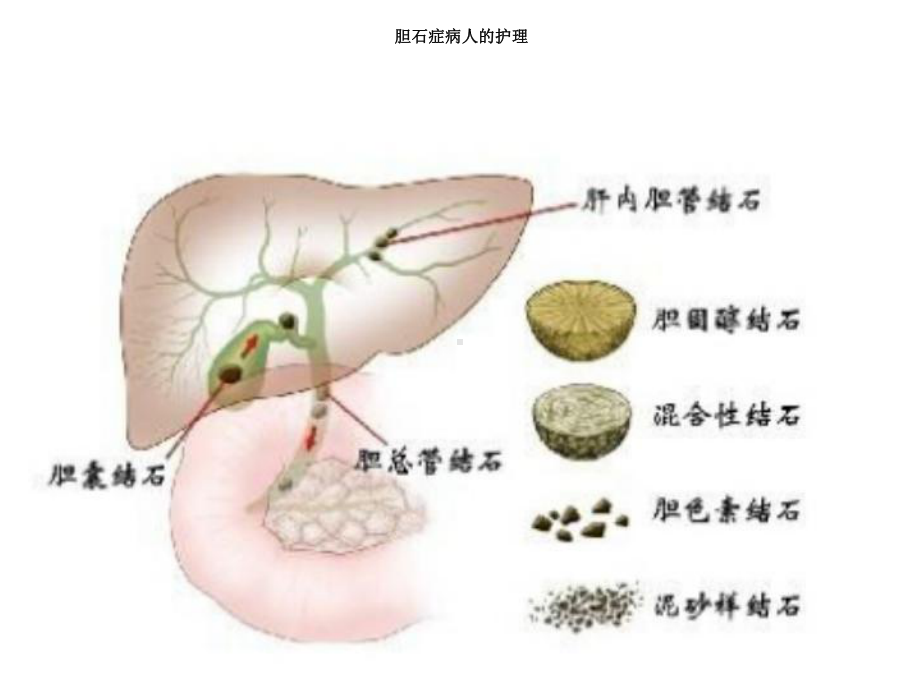 第03章第1618节-胆道疾病病人的护理课件.ppt_第3页