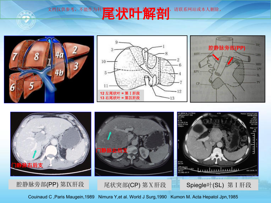 精准肝切除治疗尾状叶肝细胞癌经正中裂入路培训课件.ppt_第1页