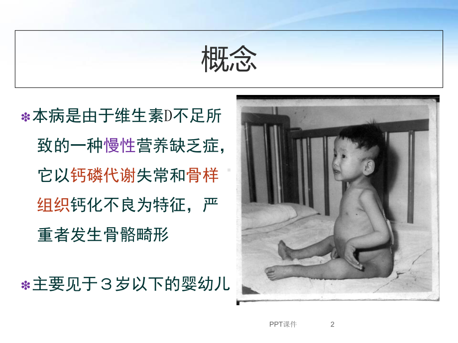 维生素D缺乏性佝偻病-课件.ppt_第2页