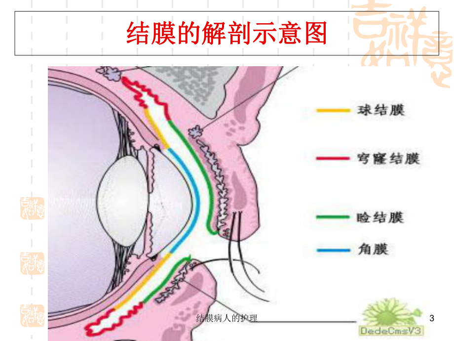 结膜病人的护理培训课件.ppt_第3页