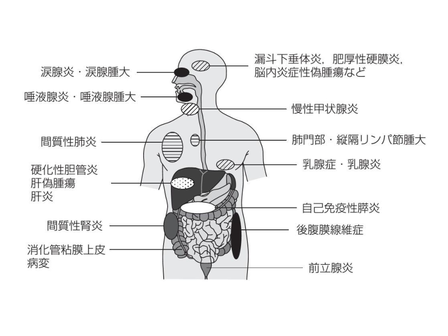 igg4相关性疾病课件-2.ppt_第3页