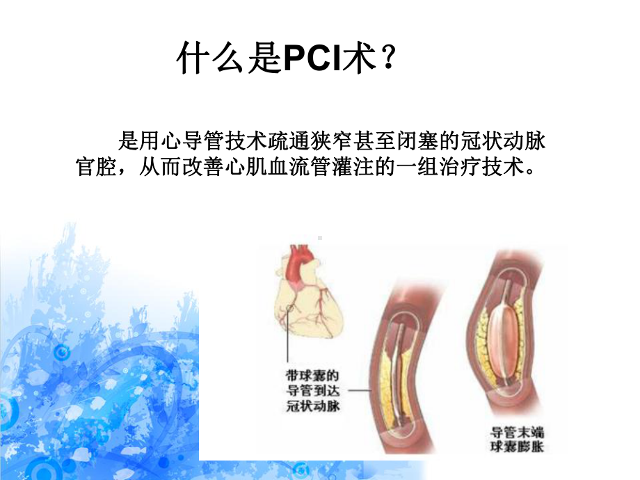 pci术前术后的护理-课件.ppt_第2页