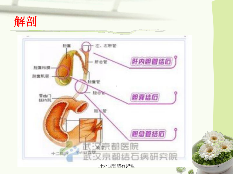 肝外胆管结石护理培训课件.ppt_第3页