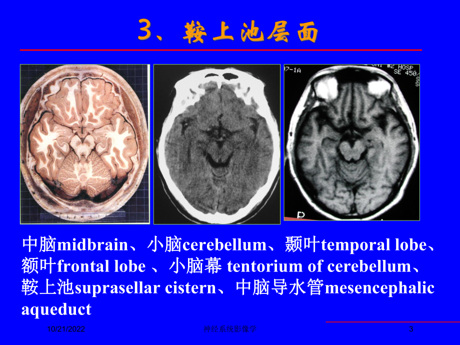 神经系统影像学培训课件.ppt_第3页