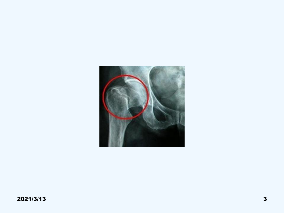 老年人股骨近段骨折分类课件.ppt_第3页