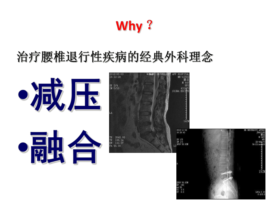 DYNESYS在腰椎退行性病变中的应用课件.ppt_第1页