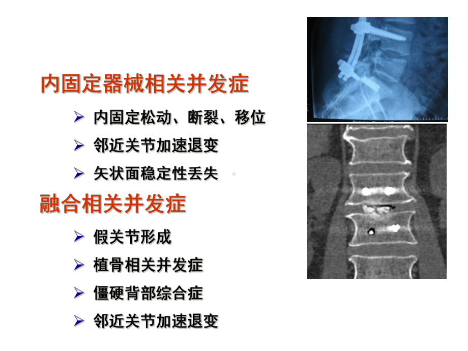 DYNESYS在腰椎退行性病变中的应用课件.ppt_第3页