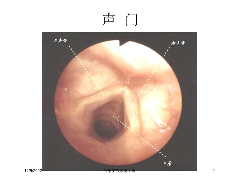 纤维支气管镜图谱培训课件.ppt_第2页