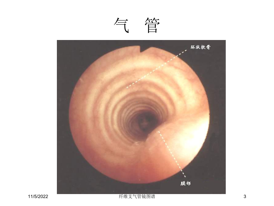 纤维支气管镜图谱培训课件.ppt_第3页