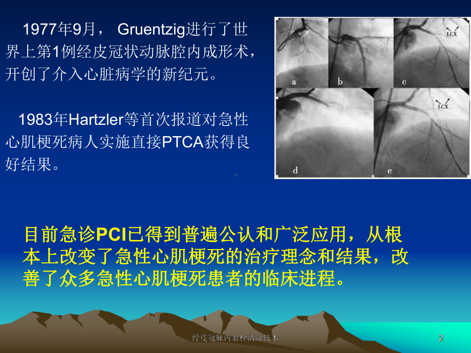 经皮冠脉内血栓清除技术课件.ppt_第2页