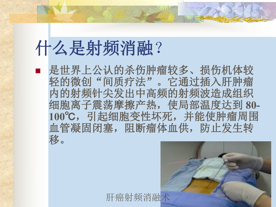 肝癌射频消融术培训课件.ppt_第3页