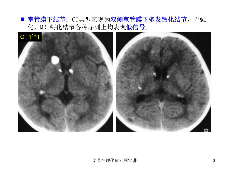 结节性硬化症专题宣讲培训课件.ppt_第3页