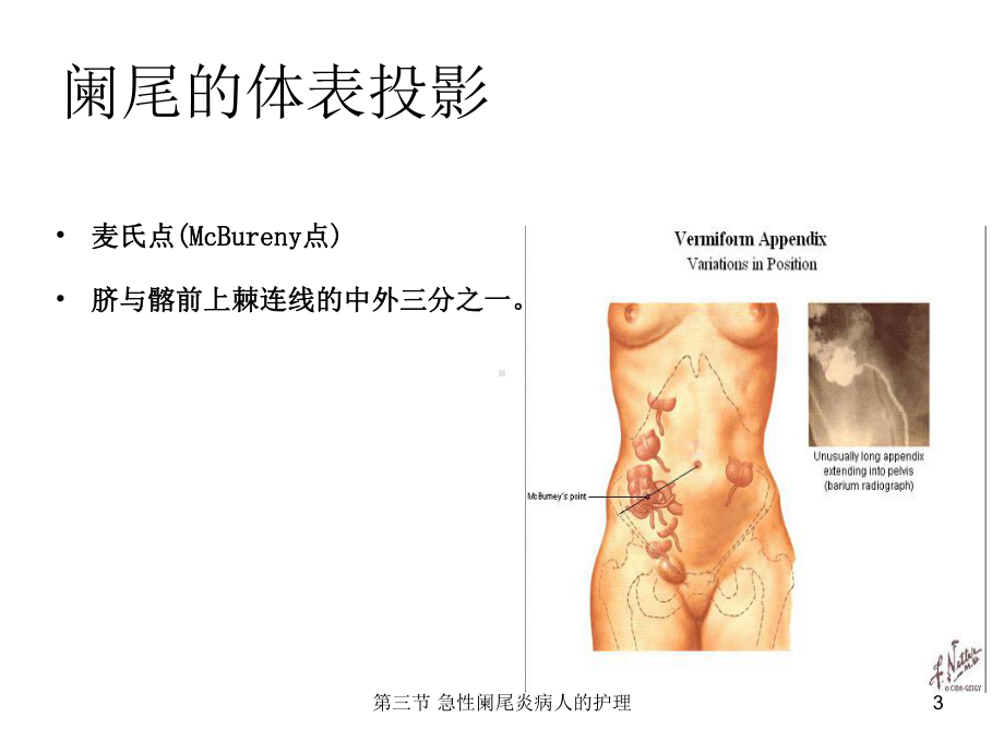 第三节-急性阑尾炎病人的护理课件.ppt_第3页