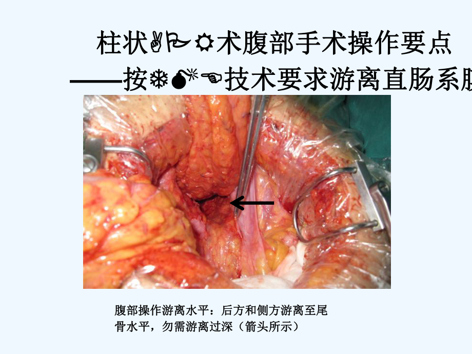 直肠癌柱状切除术临床实践与体会课件.ppt_第3页