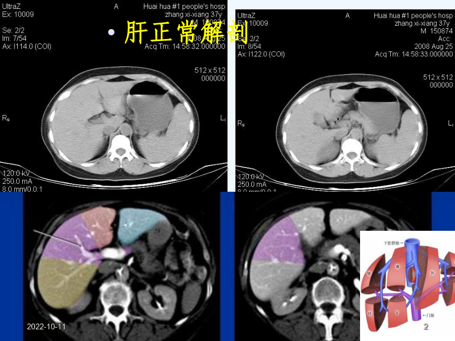 肝胆CT诊断课件-2.ppt_第2页