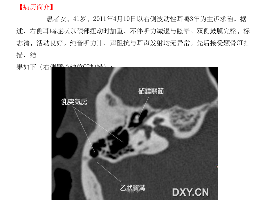 耳鸣与乙状窦憩室课件.ppt_第2页