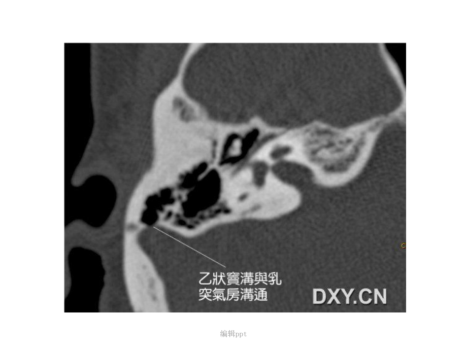 耳鸣与乙状窦憩室课件.ppt_第3页